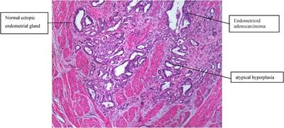 Endometrioid adenocarcinoma arising from adenomyosis: two case reports and a literature review